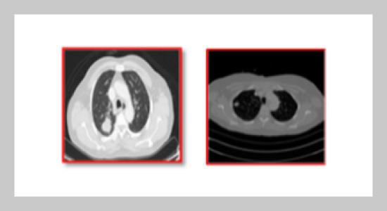 Bat-inspired Metaheuristic Convolutional Neural Network Algorithms for CAD-based Lung Cancer Prediction