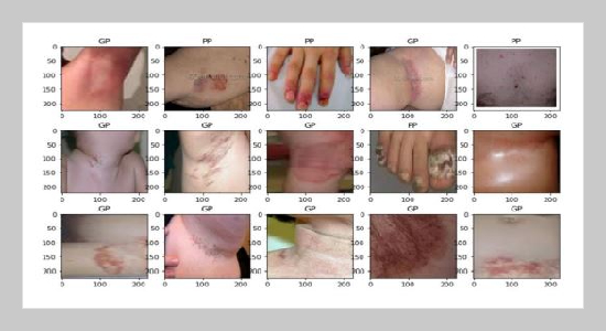 A Granular Parakeratosis Classification using SVM Hinge and Cross Validation